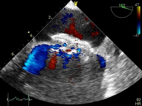 Fenestrated Atrial Septal Defect Percutaneously Occluded By A Single