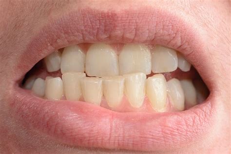 Crooked Teeth Causes And Treatment Evdp