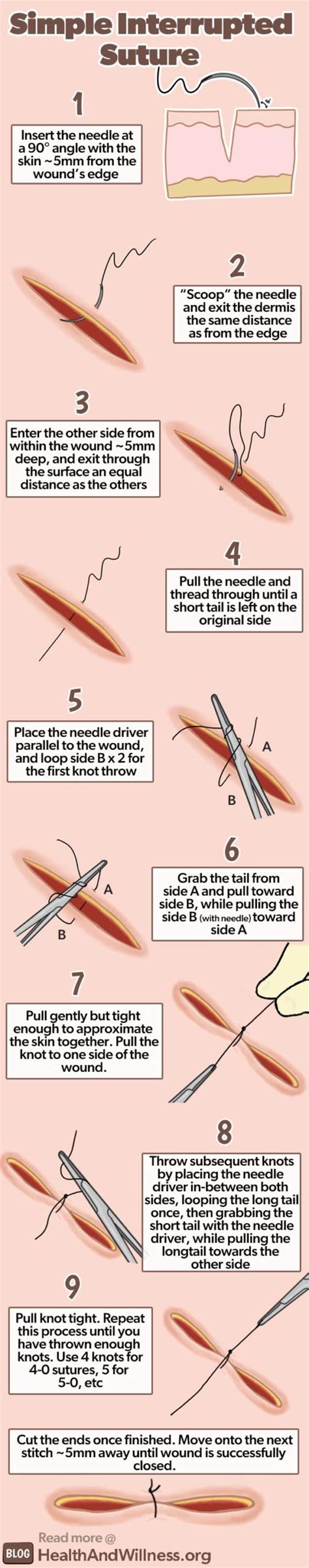 How to Suture: Simple Laceration Repair | Health And Willness