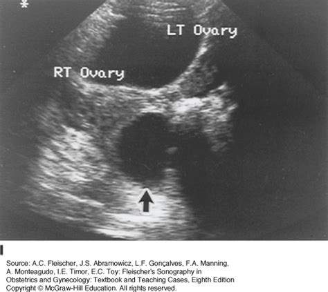 Sonographic Evaluation Of Pelvic Masses Obgyn Key