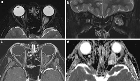 A 13-year-old boy with proptosis. MRI of the orbits with axial (a) and... | Download Scientific ...