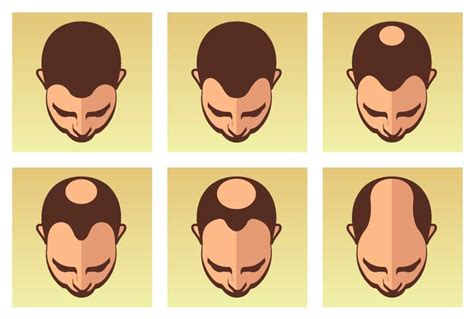 Alopecia androgénica masculina causas y tratamiento