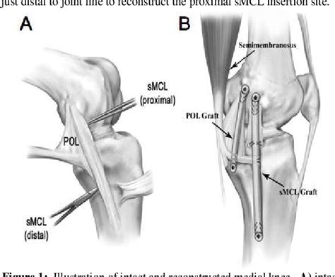 Figure From Biomechanical Analysis Of An Anatomic Medial Knee