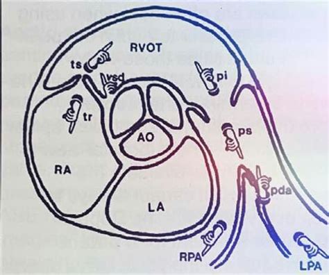 Aortic Stenosis Breaking Down The Continuity Equation Artofit