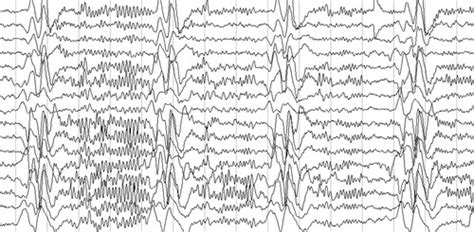 Eeg Patterns Flashcards Quizlet