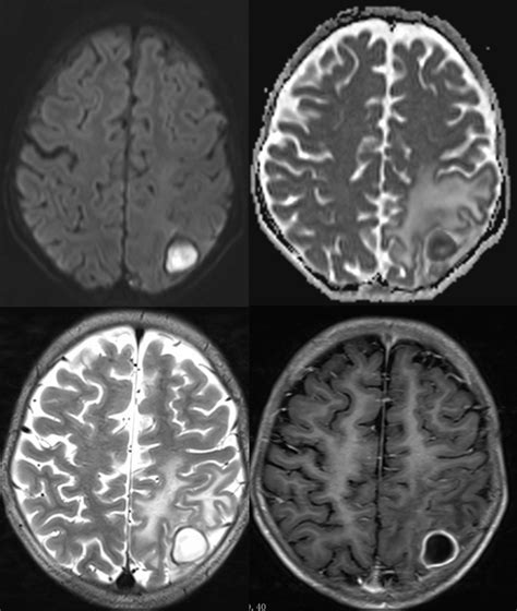 Brain Abscess Bacterial Axial DWI ADC T2W Post Contrast T1W Images