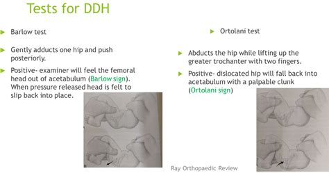 Barlow and Ortolani tests - RayOrthos