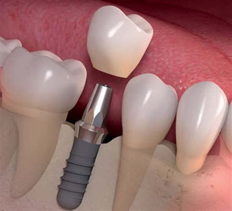 Dental Implants Everything You Need To Know Authentic Dentistry