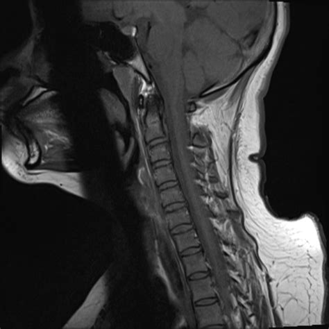 Hangman S Fracture Image Radiopaedia Org