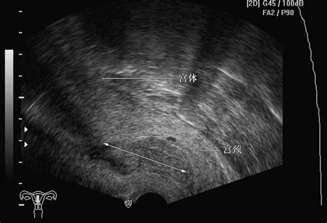 病例3 子宫黏膜下肌瘤2 妇产超声读片 医学