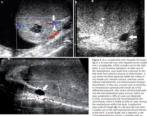 Figure 3 From Sonography Of Scrotal Abnormalities In Adults An Update