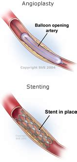 Abdominal Aortic and Iliac Artery Occlusive Disease | Oregon Surgical ...