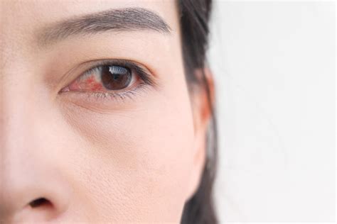 7 Pink Eye Symptoms You Should Know How to Spot