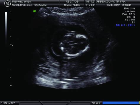 Ultrasonographic View Of Fetal Septated Cystic Hygroma Download Scientific Diagram