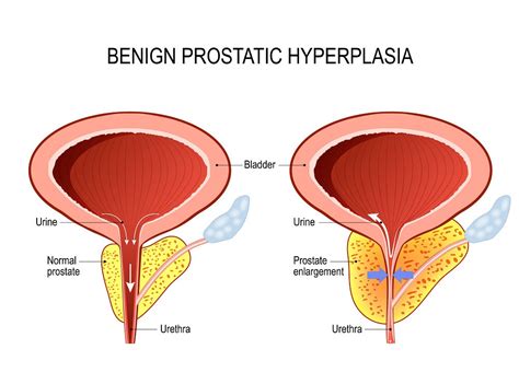 Enlarged Prostate Causes And Home Remedies Drformulas