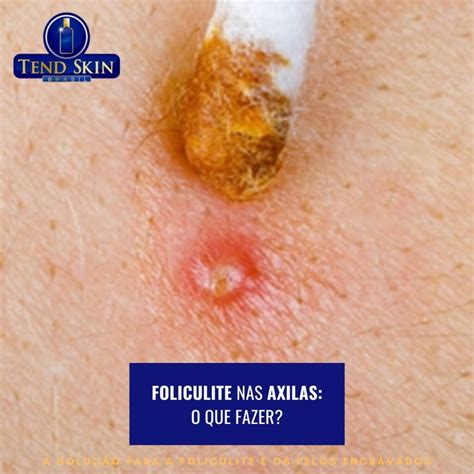 Foliculite Na Axila Dr Ensina Op Es De Tratamento