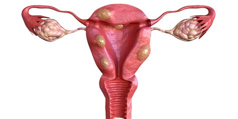 Understanding Fibroids Wilcox Fertility Pasadena Fertility Doctor