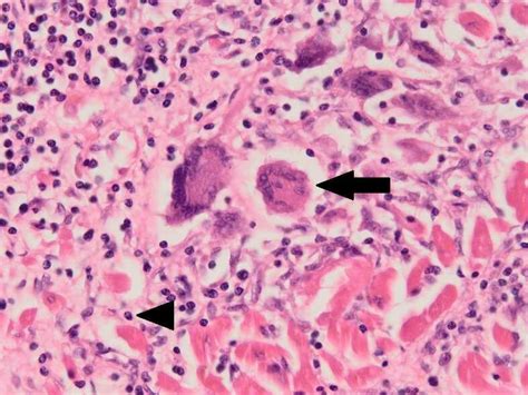 High Power Histology Section Showing Multi Nucleated Giant Cells