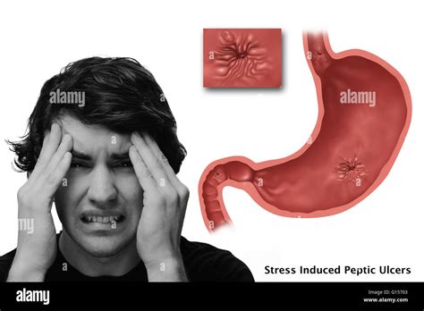 Conceptual Image Of Stress Induced Ulcers In The Illustrated Stomach