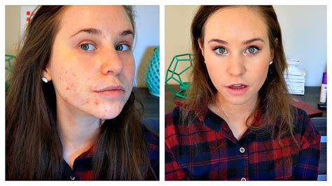 How To Cover Acne Scars With Makeup Acne Coverage Foundation Routine