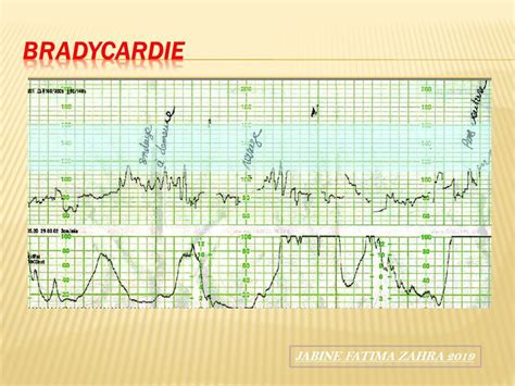 JABINE FATIMA ZAHRA Lenregistrement du rythme cardiaque fœtal ERCF
