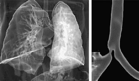 Spiral Chest Computed Tomography With Mpr Demonstrating The Right Main