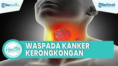 Waspadai Kanker Kerongkongan Akibat Penyakit Gerd Kenali Gejala Hingga