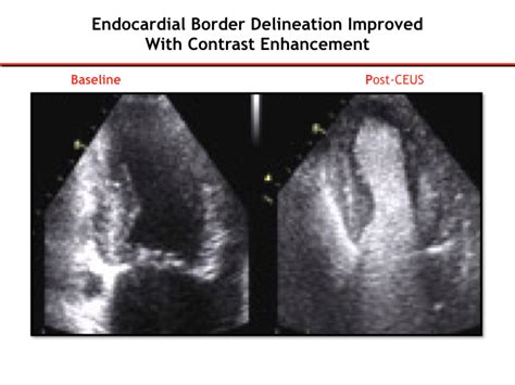 Cardiovascular Heart International Contrast Ultrasound Society