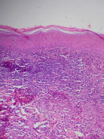 Photomicrograph Of Hande Showing Stratified Squamous Epithelium And