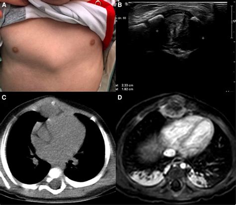 A Chest Mass B Ultrasound Echogenic Mass In The Anterior