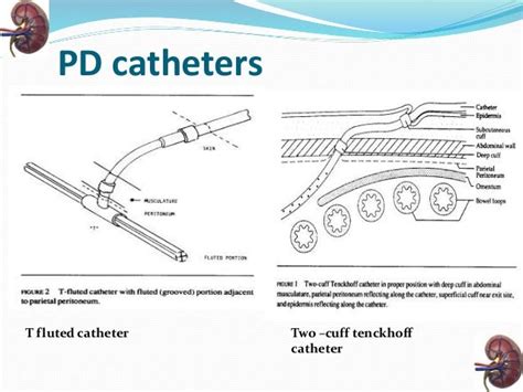 Dialysis Catheter Diagram