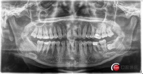 左下水平骨埋伏伴含牙囊肿智齿拔除