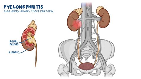 Pyelonephritis Symptoms