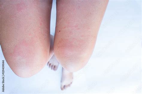 Allergic skin rash, swelling, itching. Skin allergy urticaria Stock ...