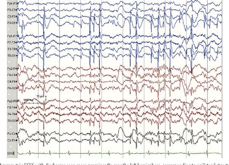 Figure 1 From Continuous Spike Wave During Slow Wave Sleep And Related