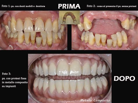 Impianti Dentali Prezzi E Costi Implantologia Dentale Dentista Resta