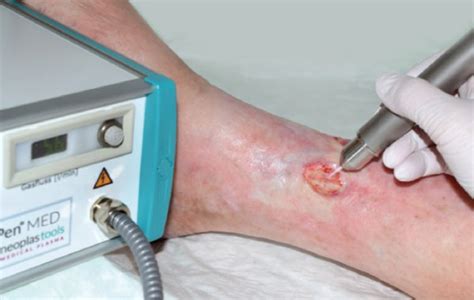 Treatment Of Chronic Ulceration With Cold Atmospheric Pressure Plasma