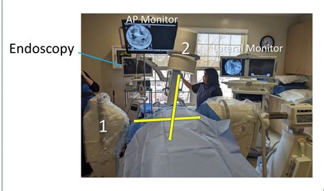 What Dual Axis C Arm Fluoroscopy Can Teach Us About Image Guidance