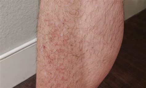 My Legs Have Tons Of Tiny Little Bumps In Clusters That Have Been Intensely Itching For Days