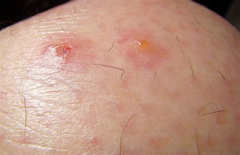 How Do You Know If You Have Chigger Bites E Fitness Edge