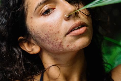 Nodulocystic Acne Causes Treatment And Recommended Care Dermastore