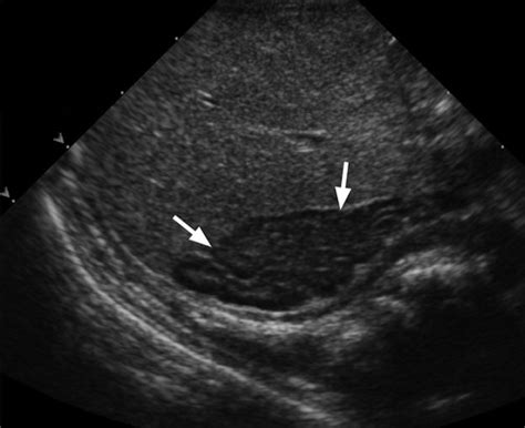 Imaging Of Ambiguous Genitalia Classification And Diagnostic Approach