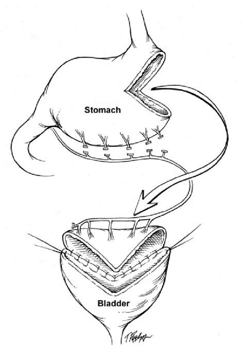 The Wedge Shaped Gastric Flap Is Brought With Its Blood Supply Close To