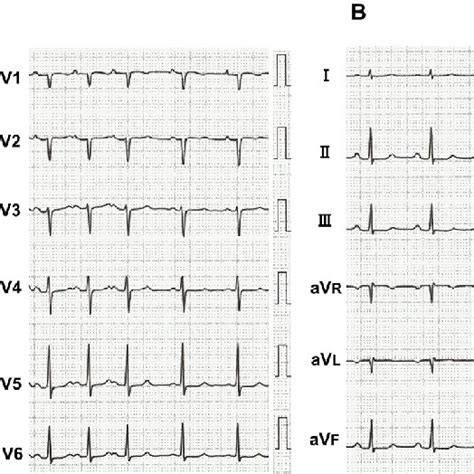 Figure1 Twelve Lead Electrocardiograms Obtained Before A And 5 Months Download Scientific