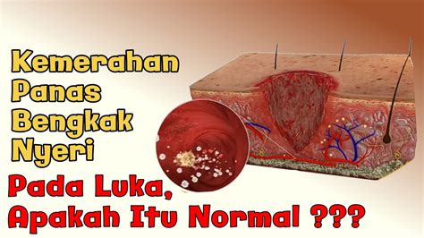 Tahapanproses Penyembuhan Luka Woundhealing Youtube