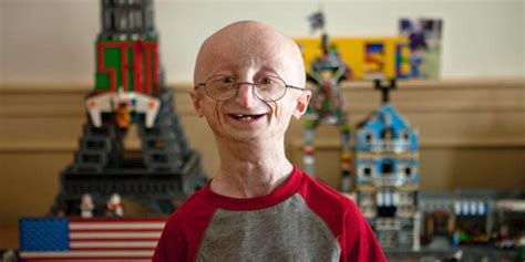 An Overview Of Progeria