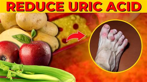 Foods That Reduce Your Uric Acid Levels Youtube