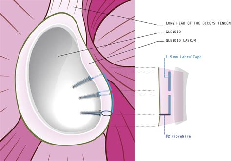 The Labral Bridge A Novel Technique For Arthroscopic Anatomic