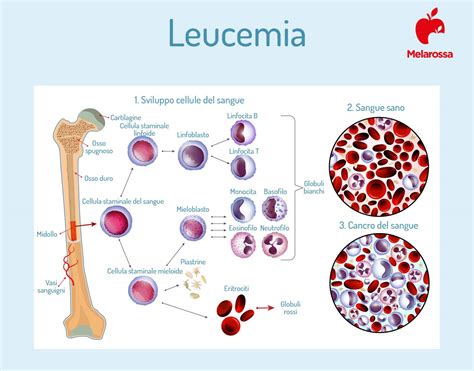 Leucemia che cos è sintomi cause diagnosi e cure