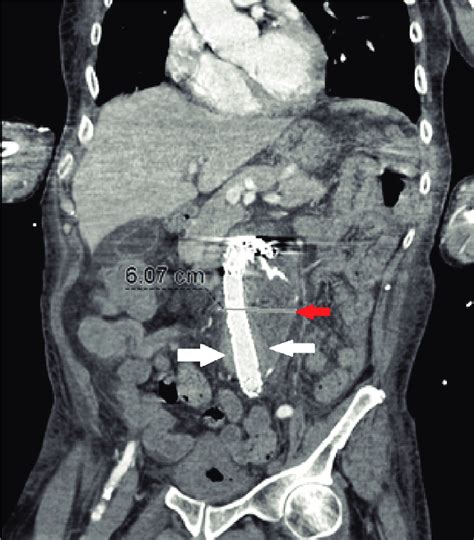 C T Abdomen And Pelvis With Iv Contrast Reveals An Approximately 6 Cm Download Scientific